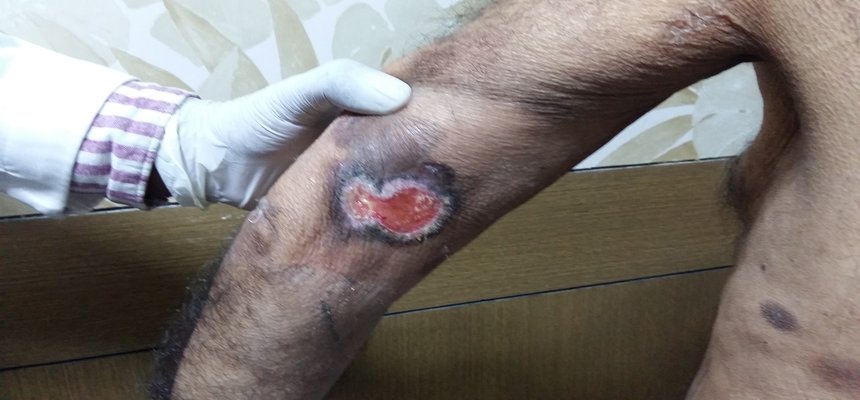 KIMS Radiation Oncologist successfully performs South India’s first Total Skin Electron Beam Radiation Therapy
