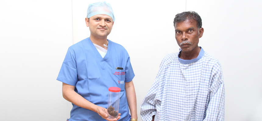 KIMS Doctors Perform a Rare Open Kidney Surgery to Save a Patients Kidney