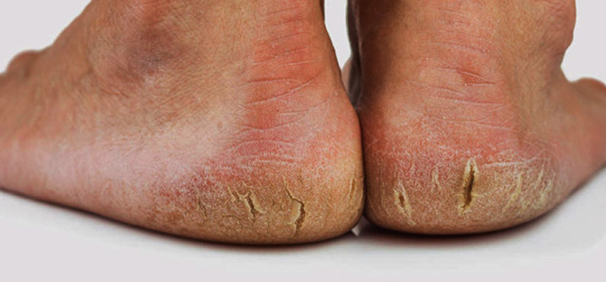 CRACKED HEELS â€“ NOT JUST A COLD WEATHER PROBLEM