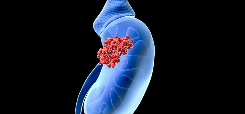 MINIMALLY INVASIVE SURGERY FOR KIDNEY CANCER PERFORMED IN KOLKATA