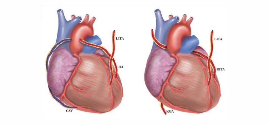Bilateral Internal Mammary Artery best for Bypass Surgery    