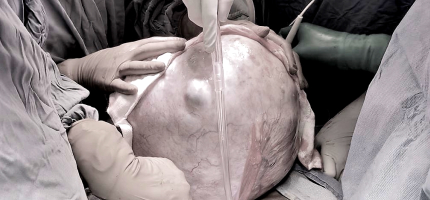 A massive 9 kg ovarian cyst removed from the abdomen of a lady