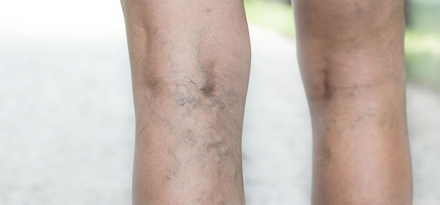 Swollen veins in the legs?