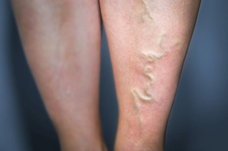 VARICOSE VEINS - A GUIDE TO UNDERSTANDING AND PREVENTING THEM