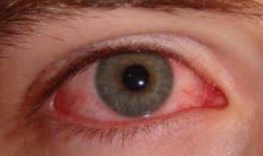CONTAIN guidelines to contain VIRAL CONJUNCTIVITIS (PINK EYE)