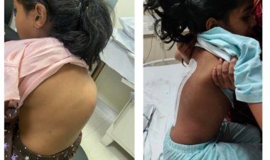 Severe Spinal Deformity in Chhattisgarh girl
