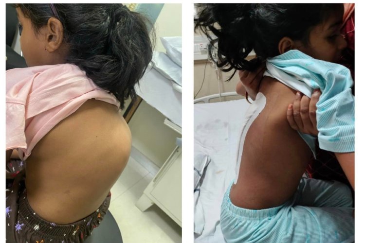 Severe Spinal Deformity in Chhattisgarh girl