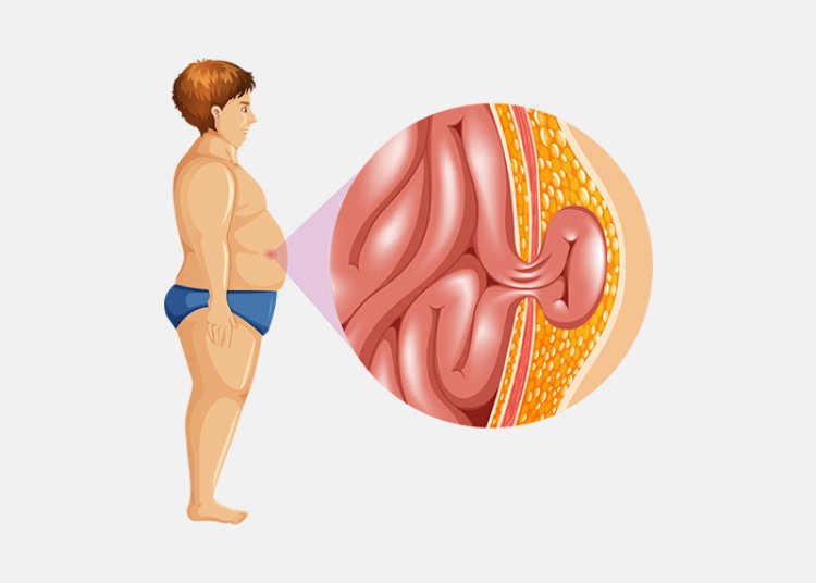 67-Year-Old Man With A Large Complicated Hernia Successfully Treated  Apollo Spectra, Pune