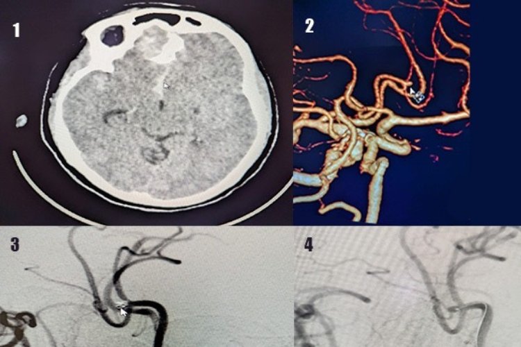 Aneurysm: Understanding the Silent Threat and Taking Preventive Measures