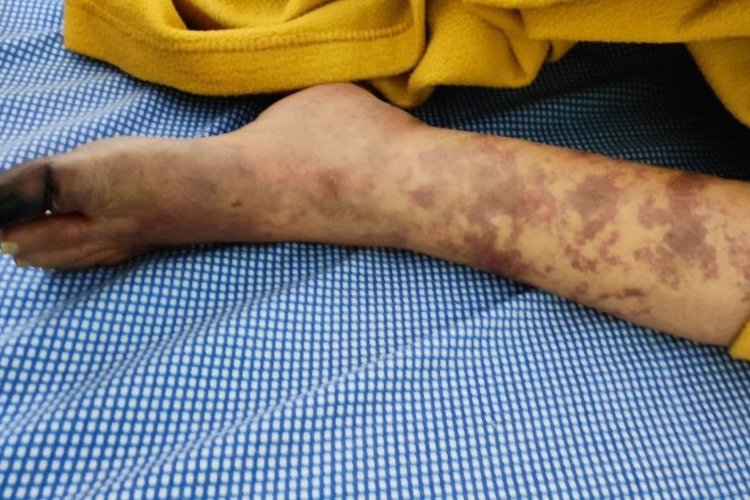 The Silent Killers: Understanding and Combating Vascular Diseases