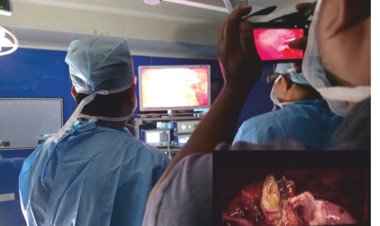 Surgeons at CARE Hospitals, Malakpet Save 72-Year-Old Woman Through High-Risk Laparoscopic Gallbladder Surgery
