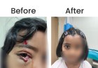 KIMS Hospitals Restores Vision Function in Six-Year-Old with Complex Eyelid Reconstruction