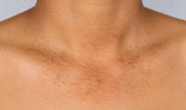 How to deal with Hyperpigmentation