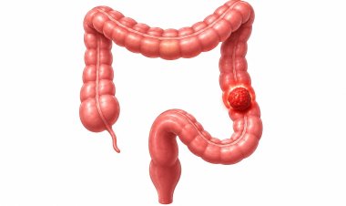 Colorectal Cancer: An emerging threat to life