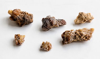 A Comprehensive Understanding of Kidney Stones