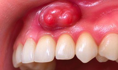 World No Tobacco Day - Oral Cancer