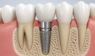 Importance of Dental Implants
