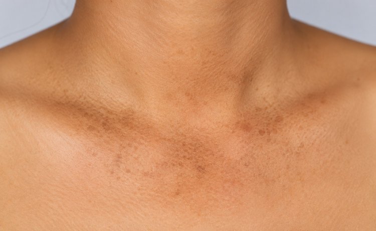 How to deal with Hyperpigmentation
