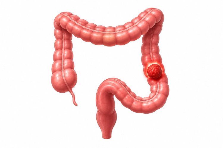 Colorectal Cancer: An emerging threat to life