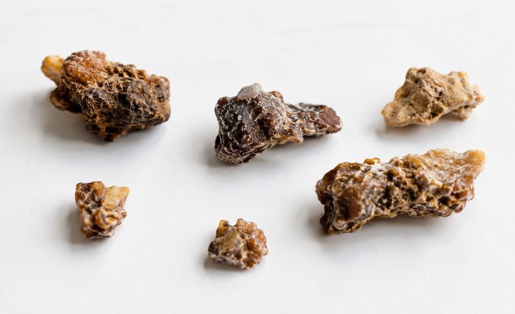 A Comprehensive Understanding of Kidney Stones