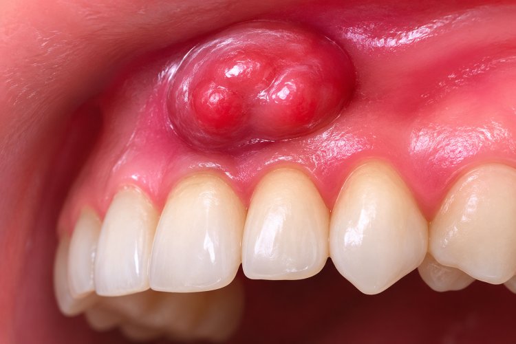 World No Tobacco Day - Oral Cancer